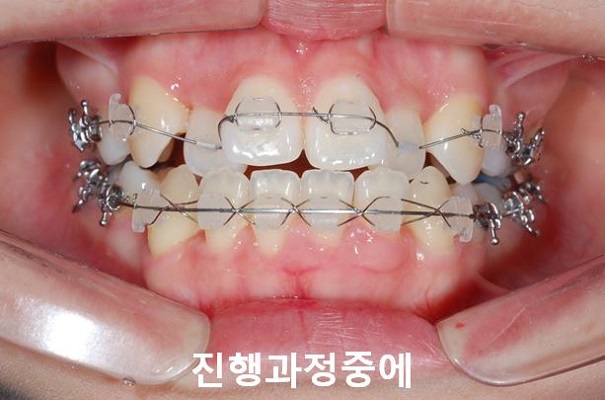덧니교정 조심할것 3가지 관련 이미지 7