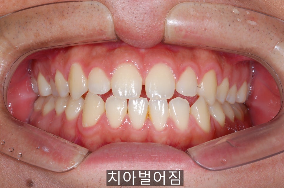 20세이상의 치아벌어짐, 교정 Vs 라미네이트! 관련 이미지 3