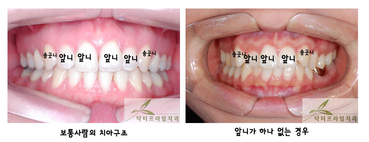 [치아교정후기] 앞니교정과 중심선이 맞지않는 부정교합 후기 관련 이미지 1