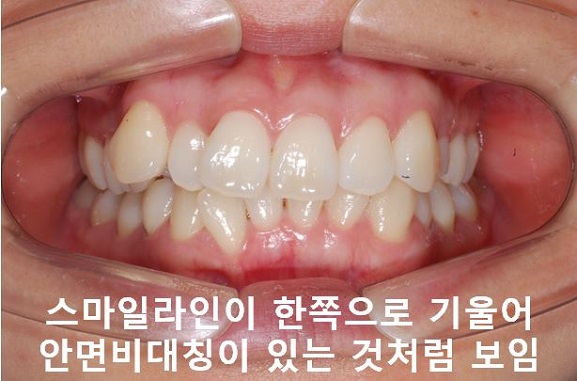 덧니교정이 곧 입매교정! 관련 이미지 11