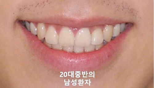 덧니교정과정, 4가지 요점만 알고 시작하세요! 관련 이미지 20