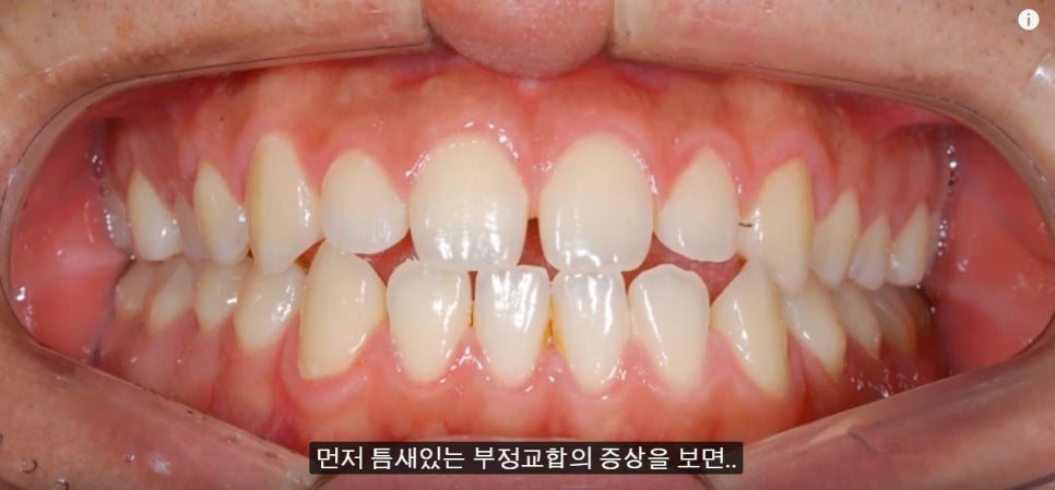 [치아교정] 치아사이에 틈새가 있는 부정교합(레진이나 라미네이트말고 치아교정으로 틈새닫기) 관련 이미지 2