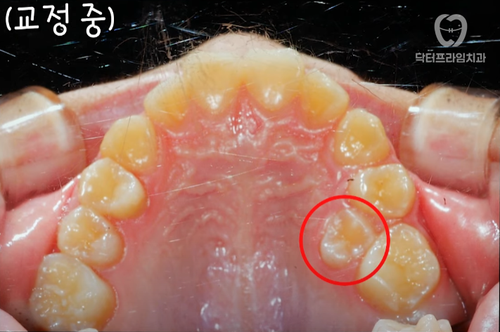 Facial asymmetry turns out to be caused by tooth alignment—can be improved with orthodontics! image 10