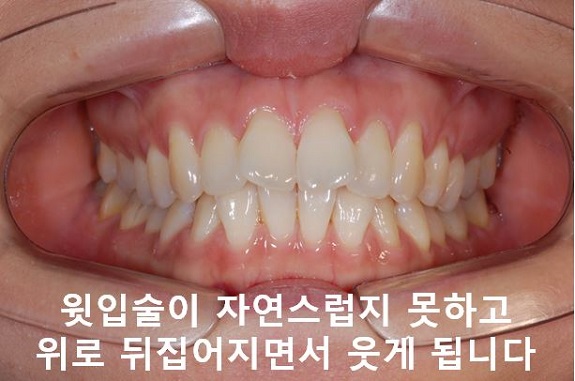 덧니교정이 곧 입매교정! 관련 이미지 7