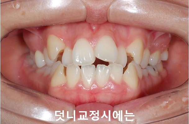 덧니교정 조심할것 3가지 관련 이미지 5