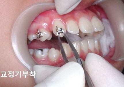 교정시작을 망설이게 하는 치아교정통증(1) 관련 이미지 5