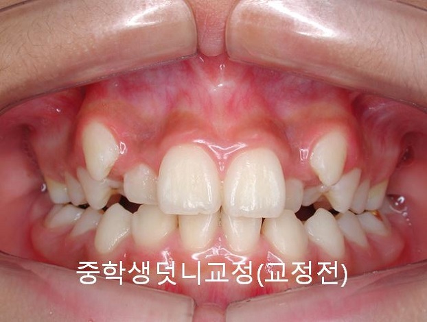 중학생덧니교정이 필요한 이유 3가지! 관련 이미지 1