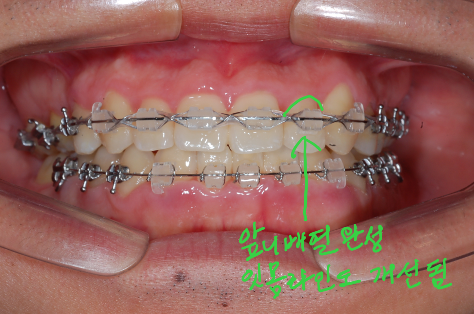 [치아교정] 안면비대칭을 숨겨라. 앞니교정+비대칭교정=상하발치교정. 들어간 앞니의 잇몸라인도 개선! 관련 이미지 6