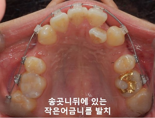 덧니교정과정, 4가지 요점만 알고 시작하세요! 관련 이미지 10