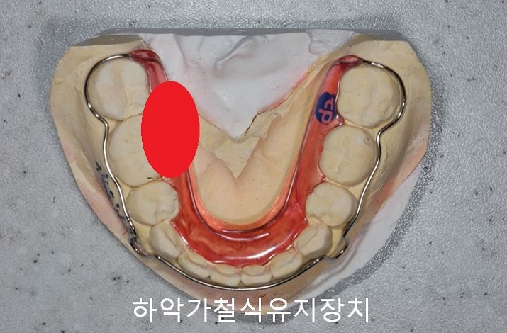 치아교정) 유지장치는 평생 해야 한다? 관련 이미지 8