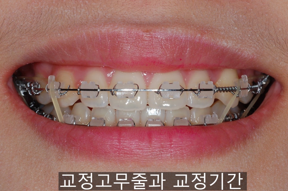 치아교정기간 짧아지는 방법 6가지! 관련 이미지 15