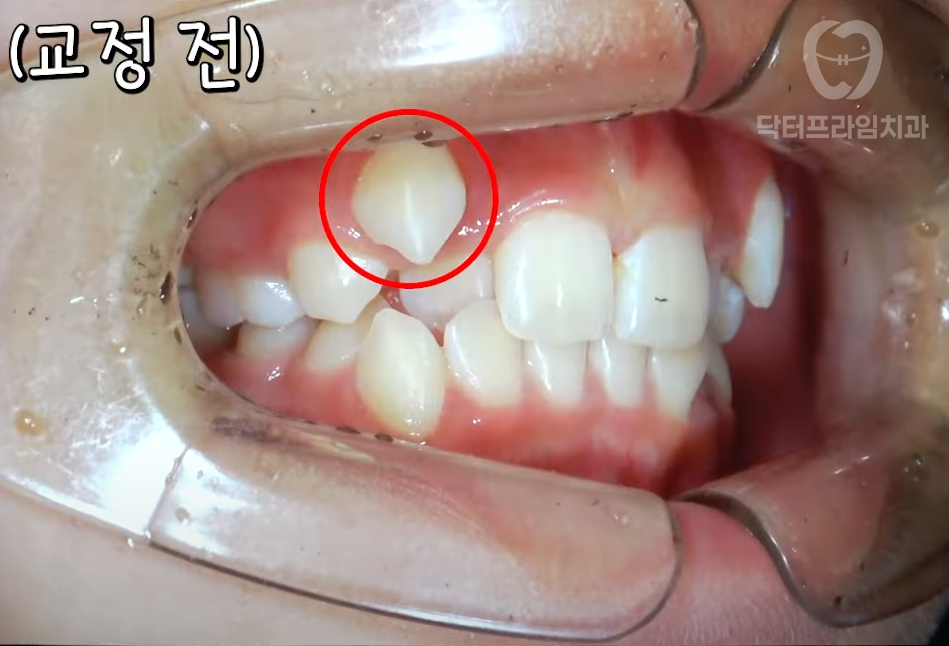 교정하면 잇몸 내려앉는다? 사실일까요, 괴담일까요? 관련 이미지 4