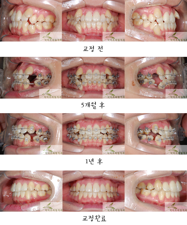 [치아교정후기] 덧니는 어릴때에는 귀여워보일수 있지만 나이가 들수록 컴플렉스가 되고ㅠㅠ 관련 이미지 1