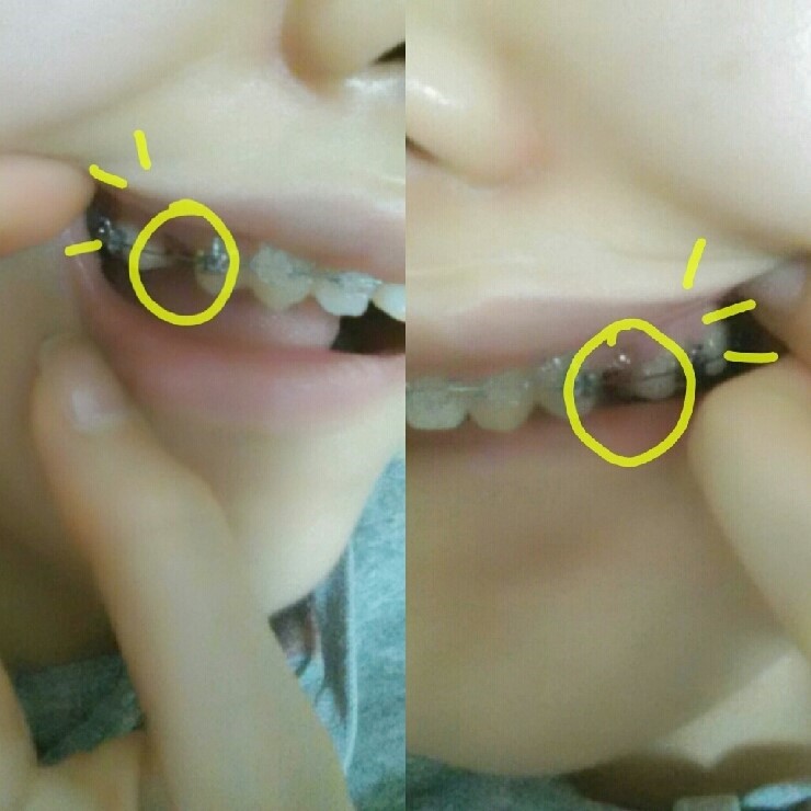 [치아교정 후기] 앞니 돌출교정 후기(2) 관련 이미지 2