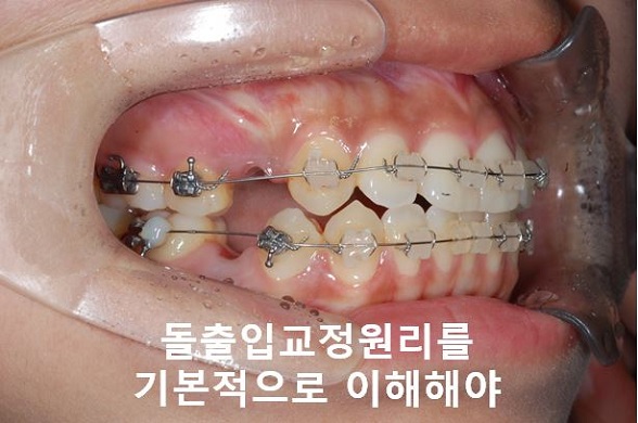 대학생 돌출입교정 망하지 않는 법! 관련 이미지 4