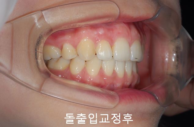 첫인상과 치아배열! 관련 이미지 9