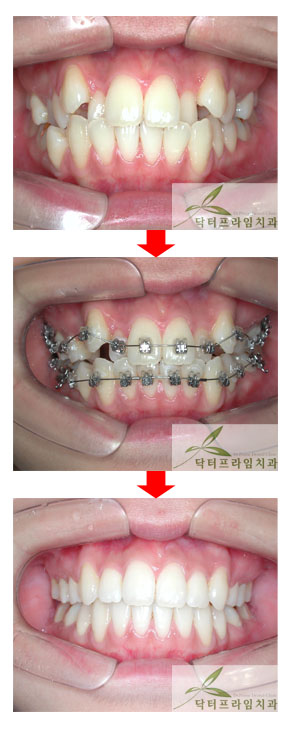[치아교정후기] 성인 덧니교정은 청소년덧니교정에 비해 어떤점이 불리할까? 관련 이미지 1