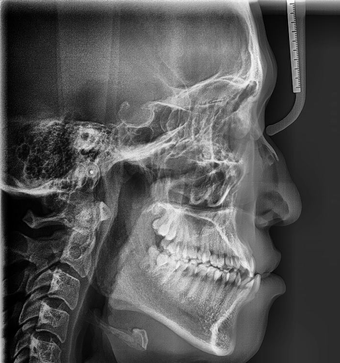 Can Braces Make the Lower Jaw Recede? When It’s Possible vs. When Surgery Is Needed image 6