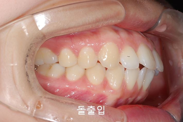 첫인상과 치아배열! 관련 이미지 3