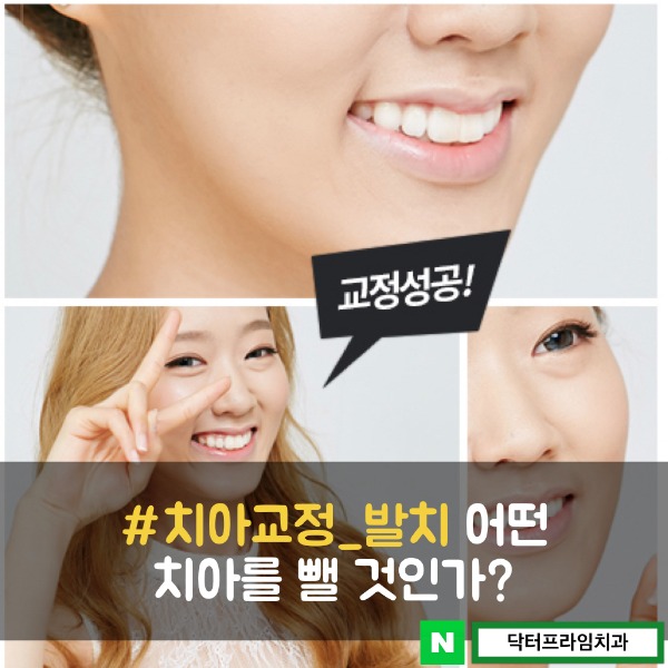 치아교정 발치 어떤 치아를 뺄 것인가? 관련 이미지 1