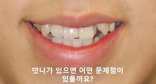 덧니교정과정, 4가지 요점만 알고 시작하세요! 관련 이미지 3