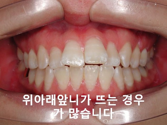 돌출입교정의 효과적인 시기! 관련 이미지 6