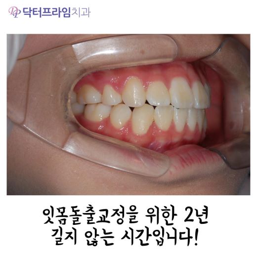 잇몸돌출교정 방법, 사진으로 보는 교정 방법! 관련 이미지 7