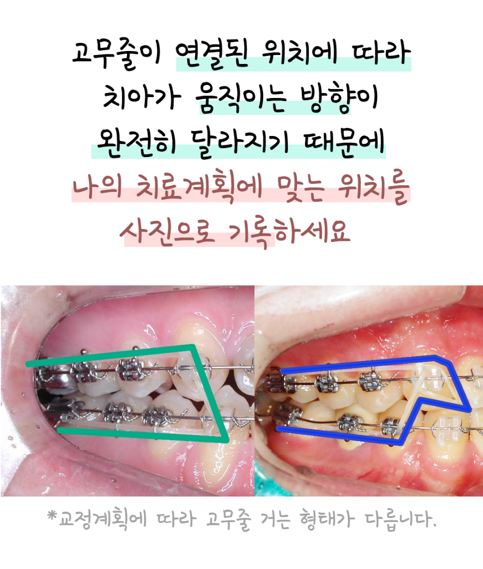 교정 고무줄, 그냥 끼는 게 아닙니다! 위치&middot;시간&middot;지속이 핵심입니다. 관련 이미지 5
