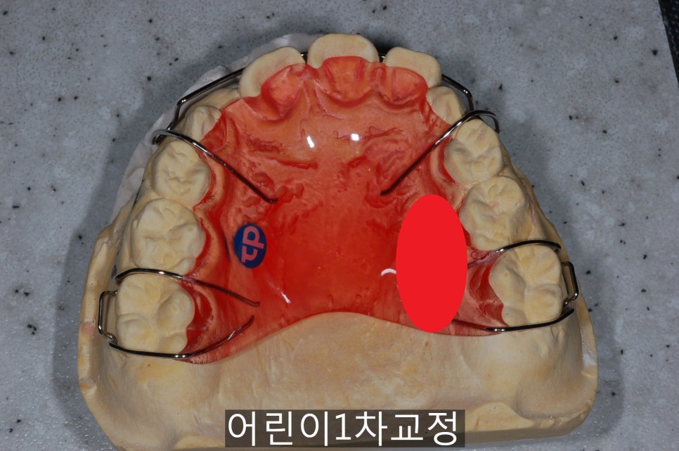 어린이 1차교정, 우리 아이도 필요할까!? 관련 이미지 4