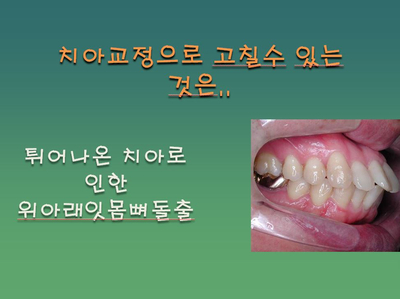 [치아교정] 양악수술과 치아교정(기본개념) 관련 이미지 1