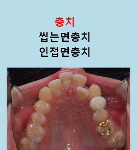 교정만으로 개선가능한 안면비대칭 알아보기(닥터프라임치과) 관련 이미지 5