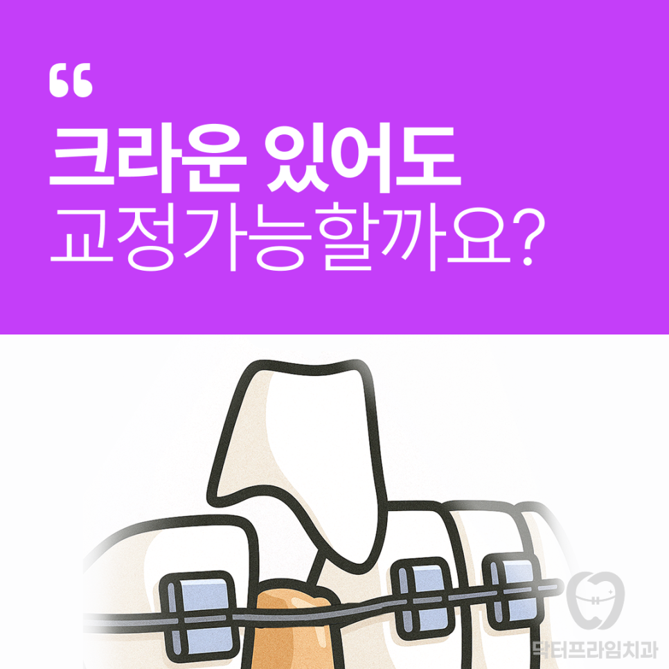 지르코니아, 골드크라운, 브릿지가 있어도 교정 가능한가요? &ndash; 주의할 점과 교정 후 관리까지 관련 이미지 13