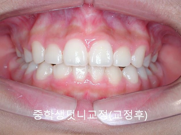 중학생덧니교정이 필요한 이유 3가지! 관련 이미지 2