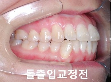 돌출입교정에 성공하는 방법 3가지! 관련 이미지 8