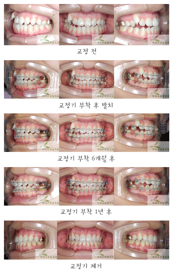 [치아교정후기] 송곳니덧니와 덧니교정전후 관련 이미지 1