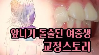 돌출입교정후기(여중생) 관련 이미지 1