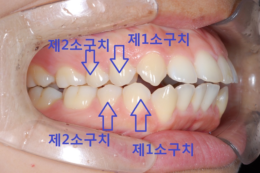 치아교정. 교정발치에 일정한 패턴이 있다?! 관련 이미지 1