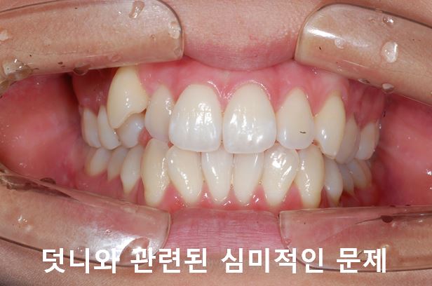 청소년, 덧니교정 안하면 이렇게 된다! 관련 이미지 6