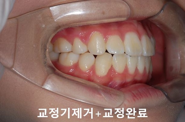 튀어나온입 교정과정 4단계요약 관련 이미지 8
