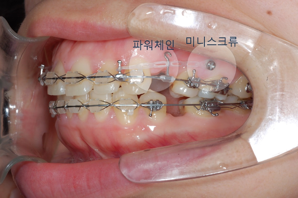 치아교정기의 구성요소(교정기, 교정철사, 미니스크류, 교정고무줄) 관련 이미지 5