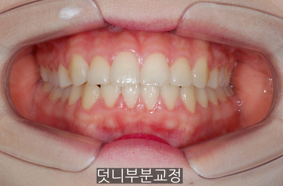 덧니부분교정하신 분들, 만족하시나요?? 관련 이미지 4