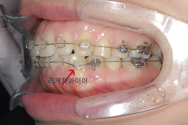 치아교정기의 구성요소(교정기, 교정철사, 미니스크류, 교정고무줄) 관련 이미지 6