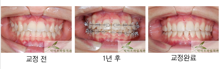 [치아교정후기] 돌출된 앞니때문에 학교생활 부적응 우려. 치아파절(치아깨짐)도 조심해야! 관련 이미지 1