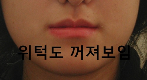 덧니와 주걱턱이 같이 있는 경우에 가장 효과적인 교정방법! 관련 이미지 21