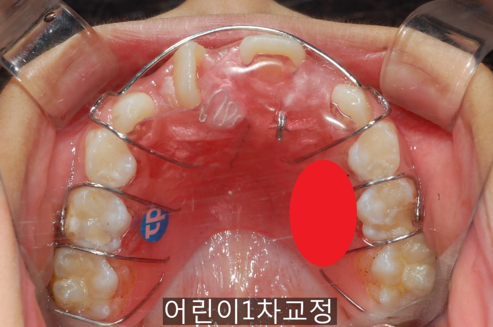 어린이 1차교정, 우리 아이도 필요할까!? 관련 이미지 2