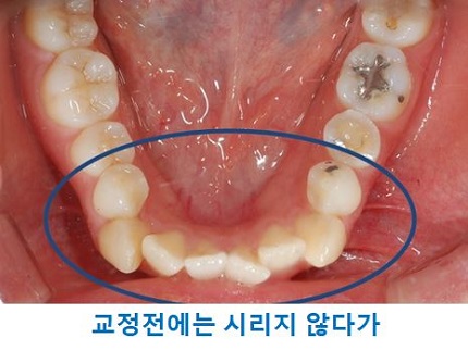 교정시작을 망설이게 하는 치아교정통증(1) 관련 이미지 11