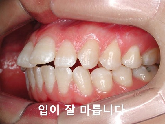 돌출입교정의 효과적인 시기! 관련 이미지 8