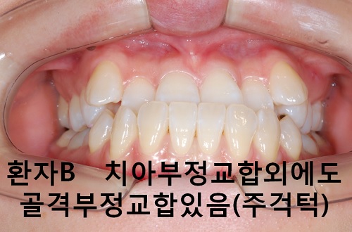 덧니와 주걱턱이 같이 있는 경우에 가장 효과적인 교정방법! 관련 이미지 5
