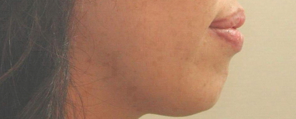 [치아교정] 돌출입발치교정후에 숨쉬기가 곤란한 경우가 있을까요?(호흡곤란) 관련 이미지 3