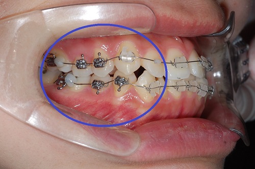 치아교정불편사항과 대처방법! (교정기에 달린 고리) 관련 이미지 3